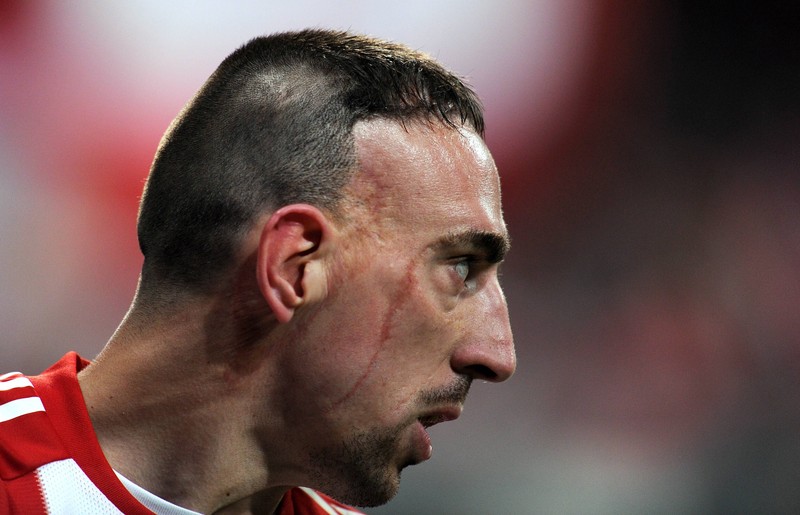 Die Narbe legte sich Franck Ribéry schon in jungen Jahren zu.